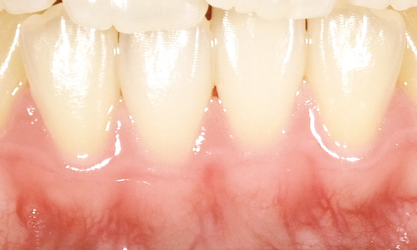 健康な歯周組織イメージ