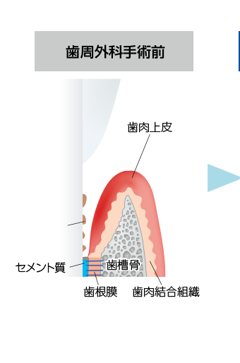 「トラフェルミン」による歯周組織再生の仕組み01