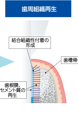 「トラフェルミン」による歯周組織再生の仕組み05