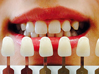 歯の色調の確認イメージ