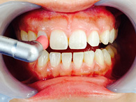 歯のクリーニングイメージ