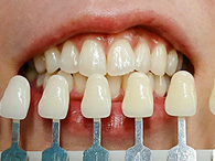 歯の色調の確認