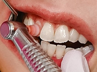 ①歯のクリーニング